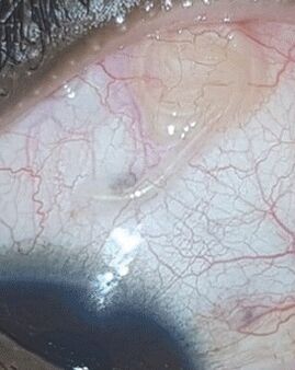 NEOflorax helped get rid of a worm in the eye