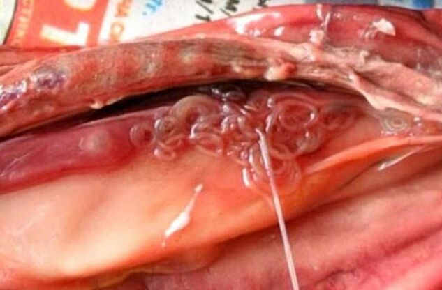 methyl in the gall bladder